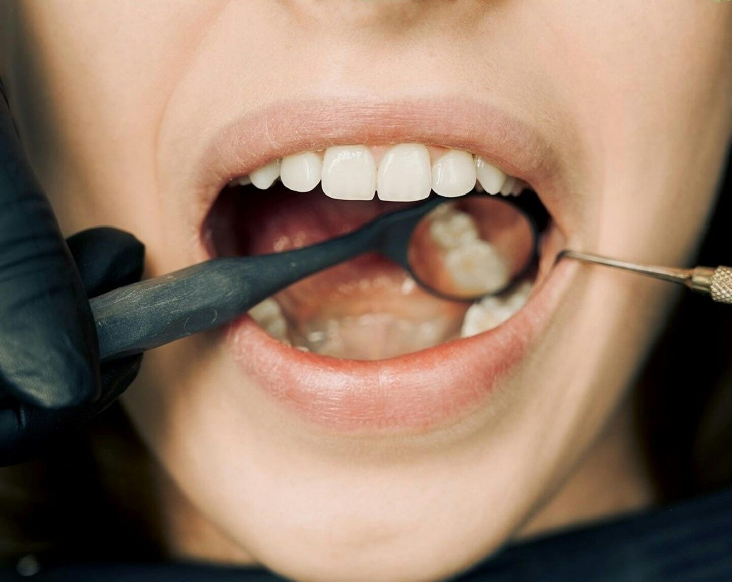 A close-up of a dental check-up, showing a patient’s open mouth while a dentist uses tools to examine the teeth.